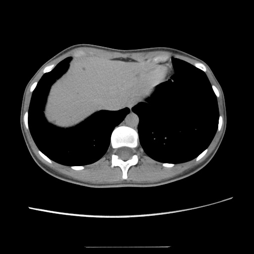 Adult polycystic kidney disease (Radiopaedia 48845-53876 Axial renal excretory phase 18).jpg