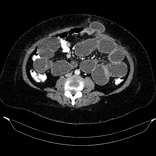 File:Afferent loop syndrome - secondary to incarcerated trocar site hernia (Radiopaedia 82959-97305 Axial C+ portal venous phase 137).jpg