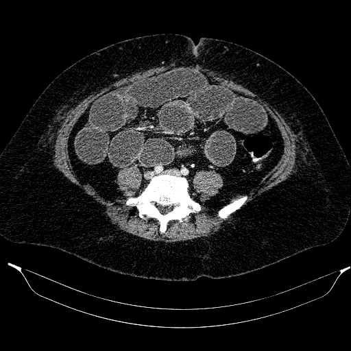 Afferent loop syndrome - secondary to incarcerated trocar site hernia (Radiopaedia 82959-97305 Axial C+ portal venous phase 159).jpg