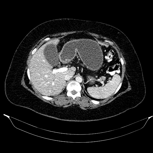 File:Afferent loop syndrome - secondary to incarcerated trocar site hernia (Radiopaedia 82959-97305 Axial C+ portal venous phase 62).jpg