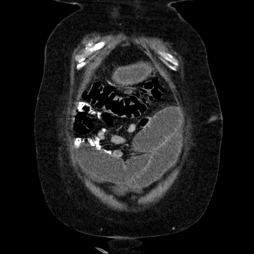 File:Afferent loop syndrome - secondary to incarcerated trocar site hernia (Radiopaedia 82959-97305 Coronal C+ portal venous phase 37).jpg