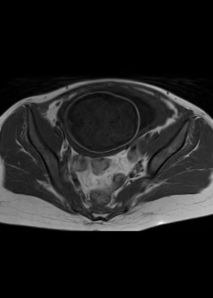 File:Aggressive angiomyxoma of the pelvis and perineum (Radiopaedia 59162-66479 T1 18).jpg