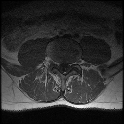 File:Aggressive vertebral hemangioma with pathological fracture (Radiopaedia 69528-79411 Axial T1 C+ 4).jpg