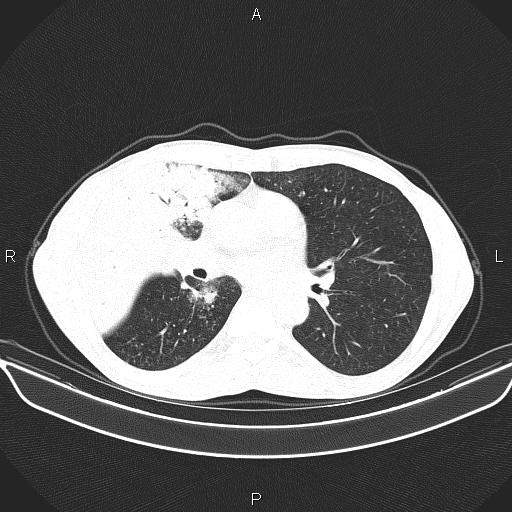 Air bronchogram in pneumonia (Radiopaedia 85719-101512 Axial lung window 35).jpg