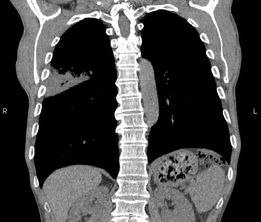 Air bronchogram in pneumonia (Radiopaedia 85719-101512 Coronal non-contrast 42).jpg