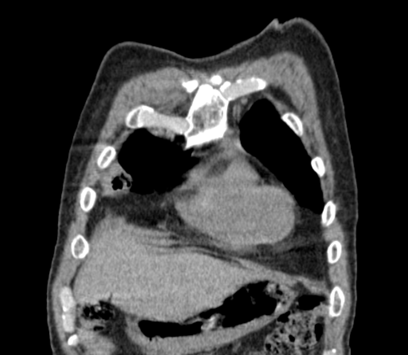 Airway foreign body in adult (Radiopaedia 85907-101779 Coronal liver window 32).jpg