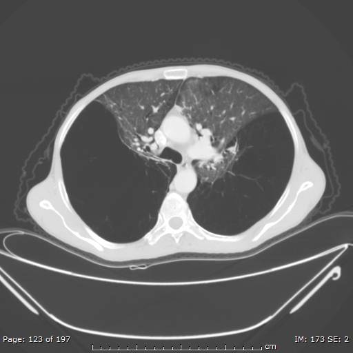 Alpha-1-antitrypsin deficiency (Radiopaedia 50561-55987 Axial lung window 52).jpg