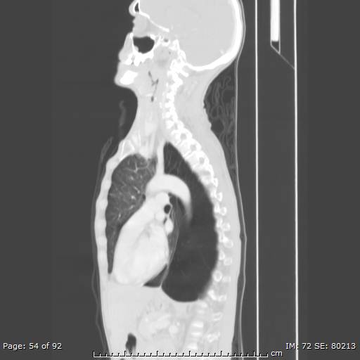 File:Alpha-1-antitrypsin deficiency (Radiopaedia 50561-55987 Sagittal lung window 26).jpg
