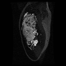 Alveolar soft part sarcoma (Radiopaedia 64501-73678 D 107).jpg