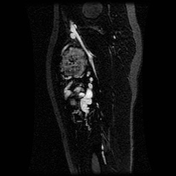 Alveolar soft part sarcoma (Radiopaedia 64501-73678 D 64).jpg