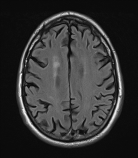 File:Alzheimer's disease- with Gerstmann syndrome and dressing apraxia (Radiopaedia 54882-61150 Axial FLAIR 20).png
