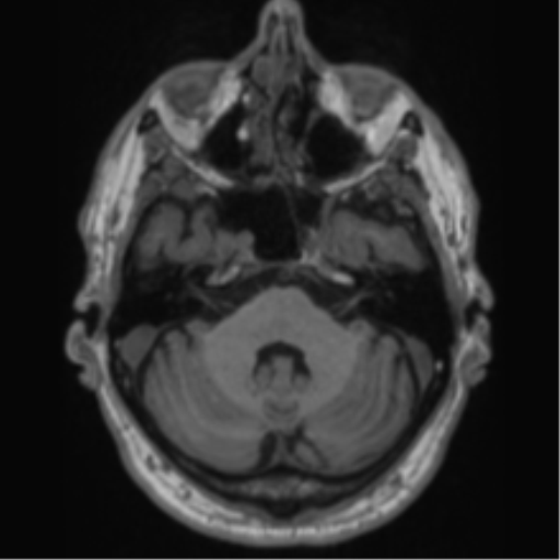 Alzheimer's disease- with Gerstmann syndrome and dressing apraxia (Radiopaedia 54882-61150 Axial T1 17).png