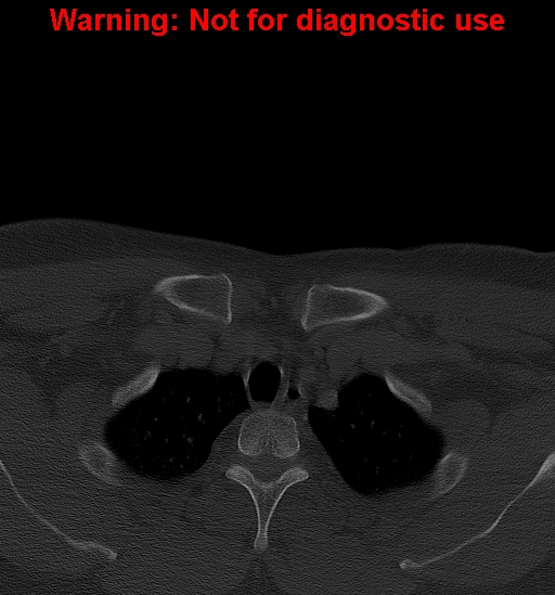 Ameloblastoma (Radiopaedia 33126-34164 Axial bone window 52).jpg