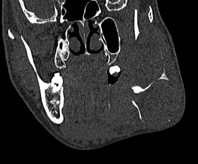 Ameloblastoma (Radiopaedia 51921-57766 Coronal bone window 110).jpg
