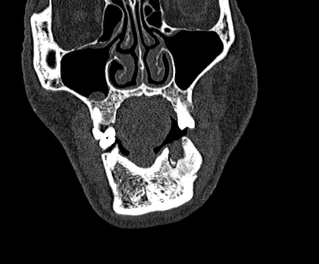 Ameloblastoma (Radiopaedia 51921-57766 Coronal bone window 52).jpg