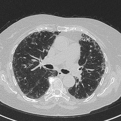 File:Amiodarone-induced pulmonary fibrosis (Radiopaedia 82355-96460 Axial lung window 31).jpg
