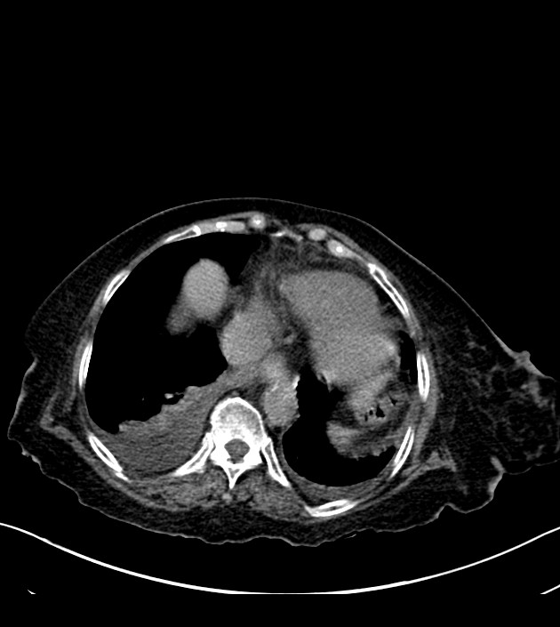Amiodarone deposition in the liver (Radiopaedia 77587-89780 Axial non-contrast 64).jpg