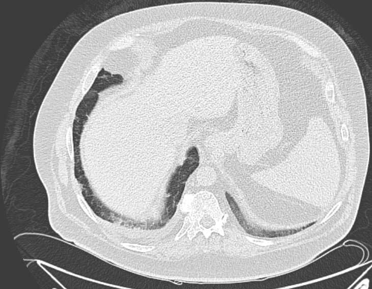 Amiodarone lung (Radiopaedia 62514-70769 Axial lung window 76).jpg