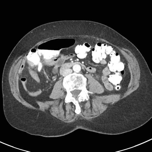 Ampullary adenocarcinoma (Radiopaedia 34013-35237 C 28).png