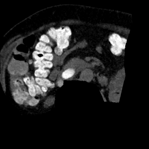 Ampullary adenocarcinoma (Radiopaedia 34013-35241 AXIAL MIPS 3-1.5 87).png