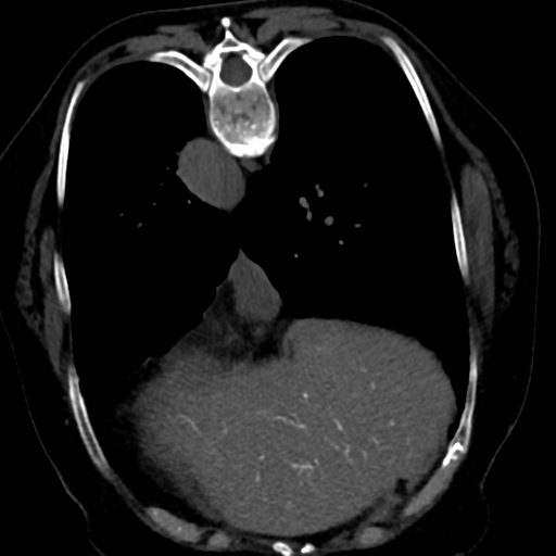 Ampullary adenocarcinoma (Radiopaedia 34013-35241 C 14).png