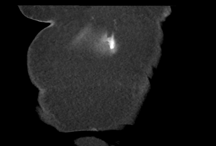 Ampullary adenocarcinoma (Radiopaedia 34013-35241 Coronal 3).png