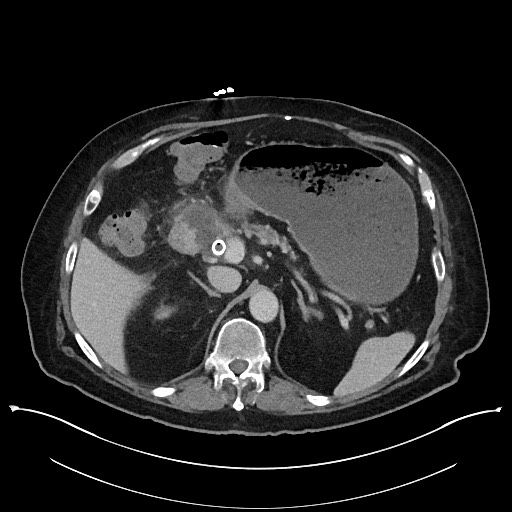 Ampullary adenocarcinoma (Radiopaedia 59373-66737 A 52).jpg