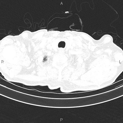 Ampullary adenocarcinoma (Radiopaedia 86093-102033 Axial lung window 12).jpg