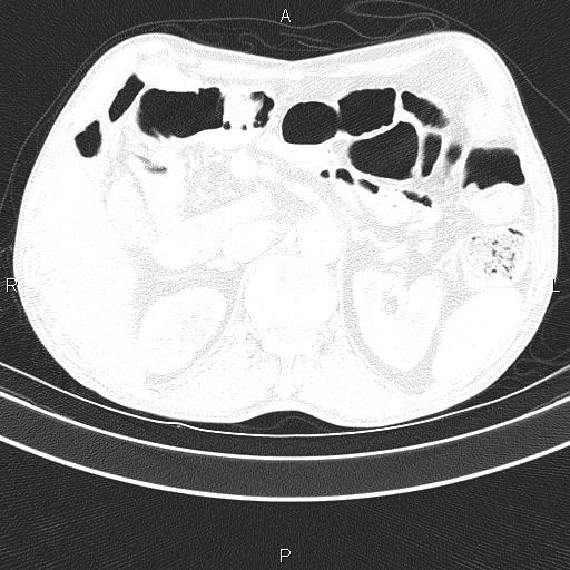 Ampullary adenocarcinoma (Radiopaedia 86093-102033 Axial lung window 60).jpg