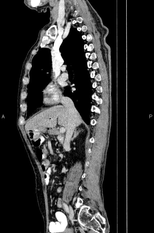 Ampullary adenocarcinoma (Radiopaedia 86093-102033 E 36).jpg