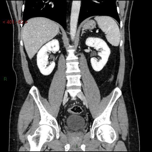 Ampullary carcinoma (Radiopaedia 56396-63056 E 61).jpg
