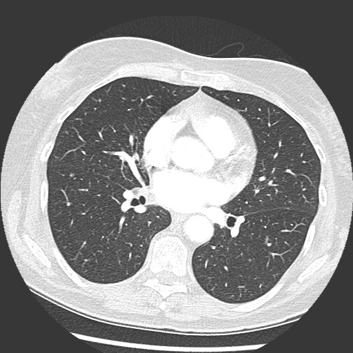 Amyloidosis - bronchial and diffuse nodular pulmonary involvement (Radiopaedia 60156-67745 Axial lung window 45).jpg