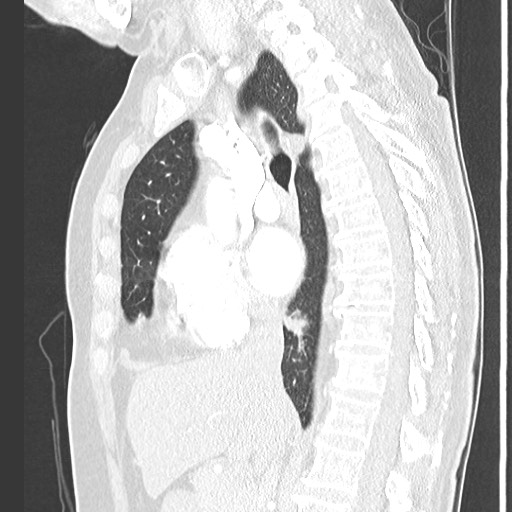Amyloidosis - bronchial and diffuse nodular pulmonary involvement (Radiopaedia 60156-67745 Sagittal lung window 42).jpg