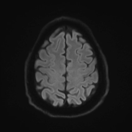 File:Amyotrophic lateral sclerosis (Radiopaedia 87352-103658 Axial DWI 51).jpg