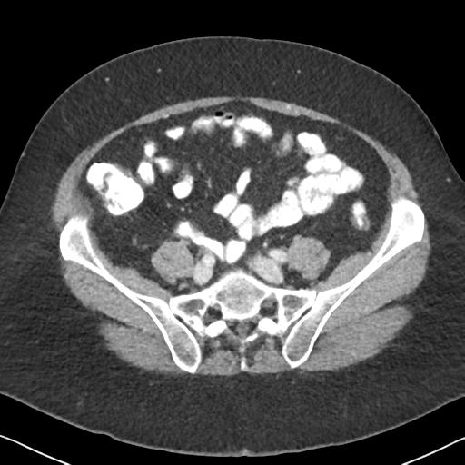 Anal adenocarcinoma - tumor regression grade 1 (Radiopaedia 31358-32103 Axial POST 52).jpg
