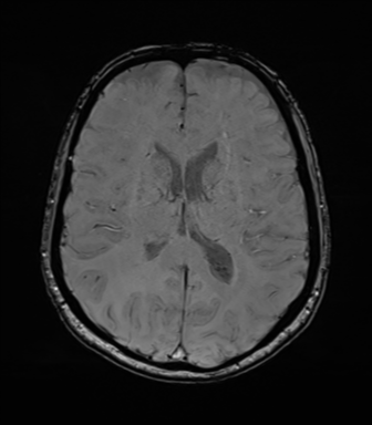 Anaplastic astrocytoma (Radiopaedia 86943-103160 Axial SWI 53).png