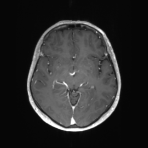 File:Anaplastic astrocytoma (Radiopaedia 86943-103160 Axial T1 C+ 20).png