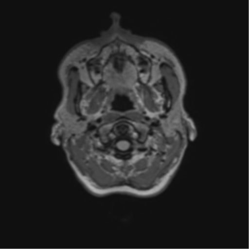 File:Anaplastic astrocytoma IDH mutant (Radiopaedia 50046-55341 Axial FLAIR 2).png
