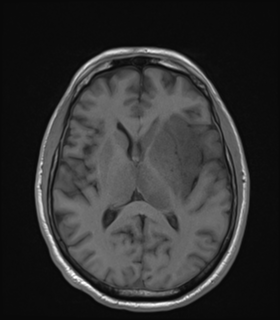 Anaplastic astrocytoma IDH wild-type (Radiopaedia 49984-55273 Axial T1 31).png