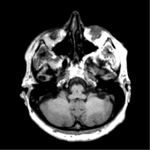 Anaplastic astrocytoma IDH wild-type (pseudoprogression) (Radiopaedia 42209-45277 Axial T1 27).png