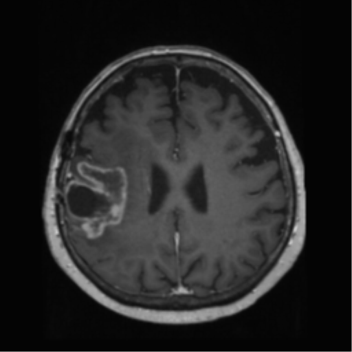 File:Anaplastic astrocytoma IDH wild-type (pseudoprogression) (Radiopaedia 42209-45278 Axial T1 C+ 102).png