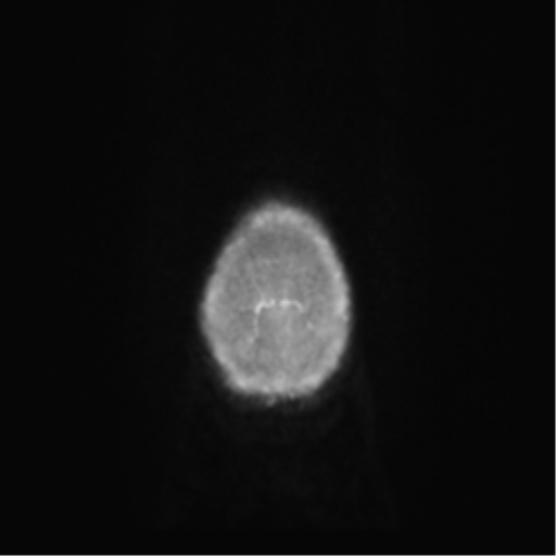 Anaplastic oligodendroglioma (Radiopaedia 83500-98599 Axial T1 C+ 79).png