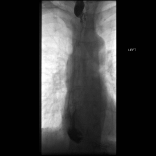 File:Anastomotic stricture post Ivor Lewis esophagectomy (Radiopaedia 47937-52715 B 39).png