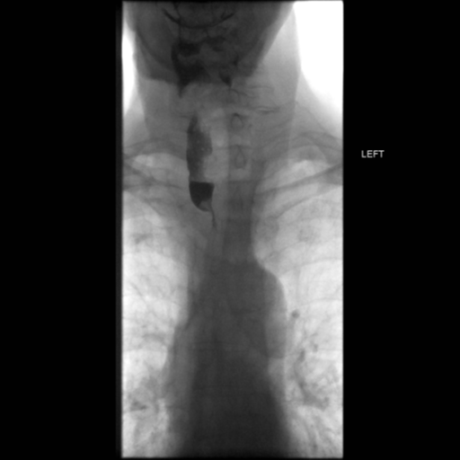 File:Anastomotic stricture post Ivor Lewis esophagectomy (Radiopaedia 47937-52715 Frontal 4).png