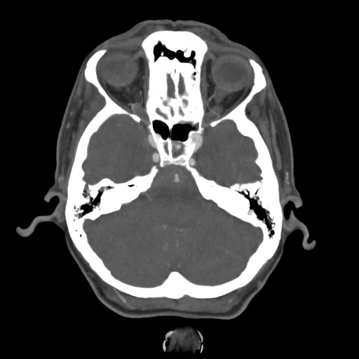 Aneursym related subarachnoid hemorrhage with hydrocephalus (Radiopaedia 45105-49084 A 15).jpg