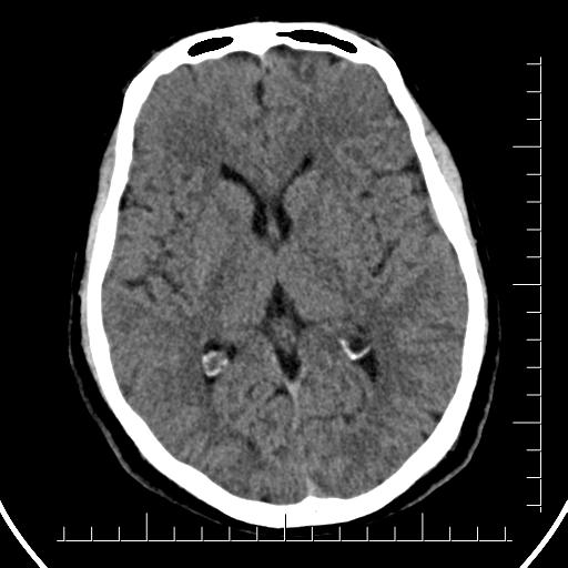 File:Aneurysm of posterior communicating artery (Radiopaedia 20188-20162 Axial non-contrast 25).jpg