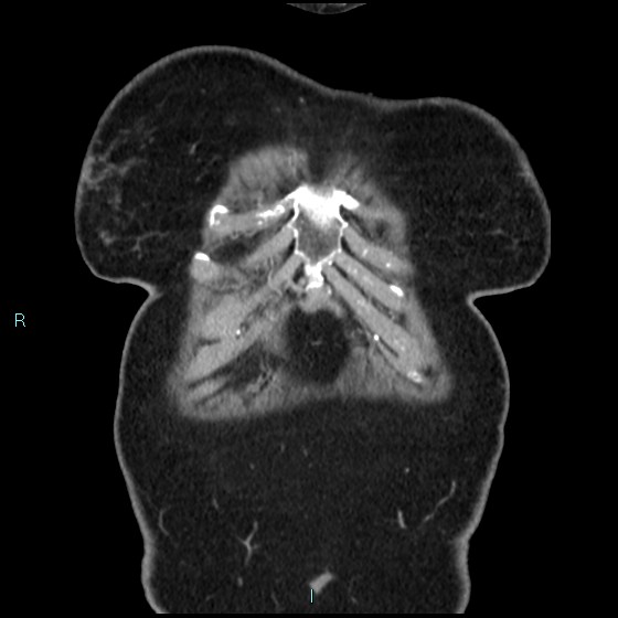 Aneurysm of the inferior vena cava (Radiopaedia 65330-74361 C 4).jpg