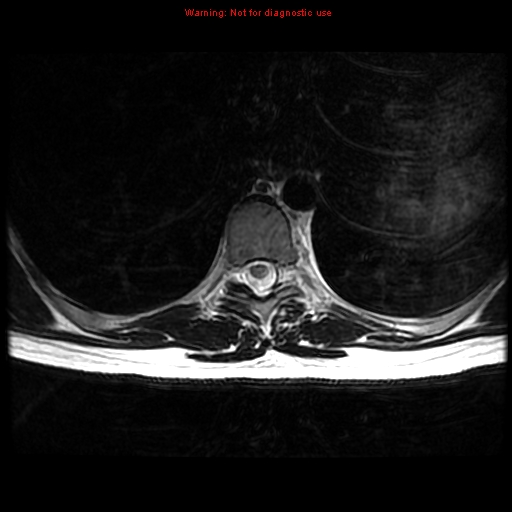 File:Aneurysmal bone cyst (Radiopaedia 9419-10103 Axial T2 5).jpg