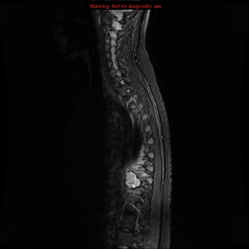 File:Aneurysmal bone cyst (Radiopaedia 9419-10103 Sagittal T2 9).jpg