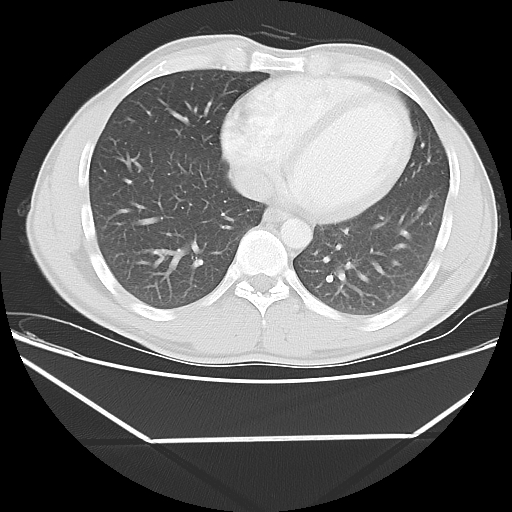 File:Aneurysmal bone cyst - rib (Radiopaedia 82167-96220 Axial lung window 45).jpg